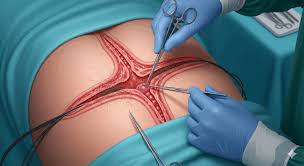 Cholecystectomy